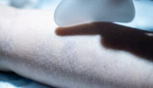 A Gua Sha tool is making contact with an infant's back; the infant's subcutaneous blood vessels are clearly visible, highlighting the delicate nature of the baby's skin.