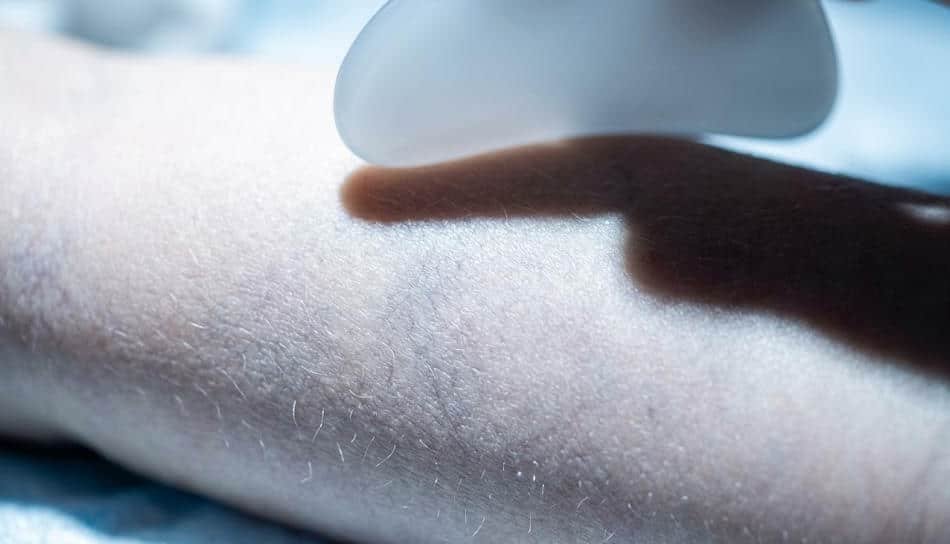 A Gua Sha tool is making contact with an infant's back; the infant's subcutaneous blood vessels are clearly visible, highlighting the delicate nature of the baby's skin.