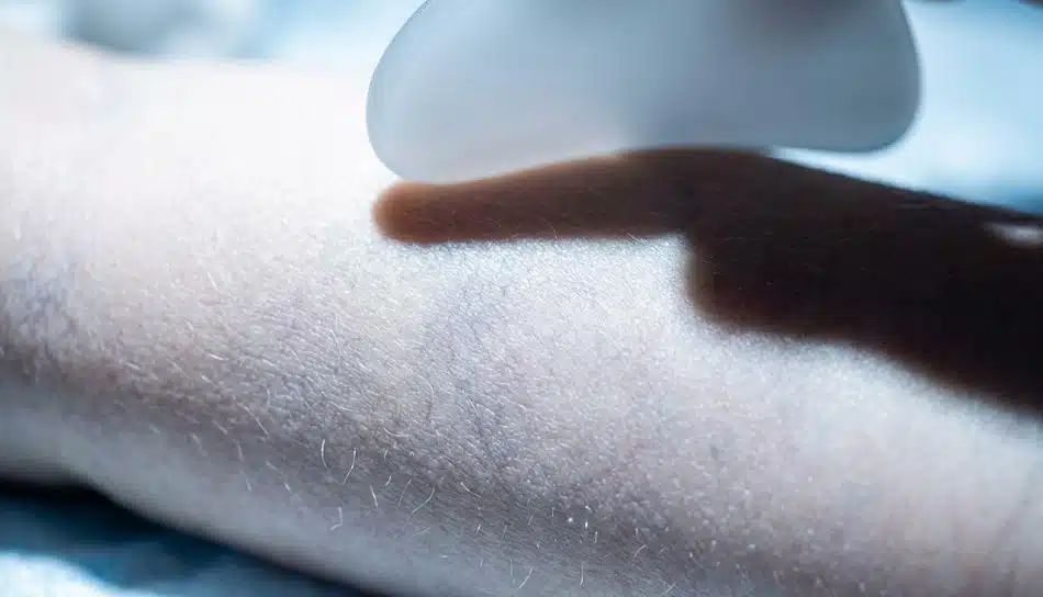 A Gua Sha tool is making contact with an infant's back; the infant's subcutaneous blood vessels are clearly visible, highlighting the delicate nature of the baby's skin.