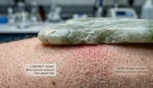 downsides of gua sha